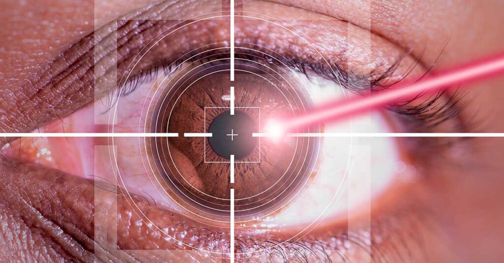 Lazer Göz Ameliyatı
